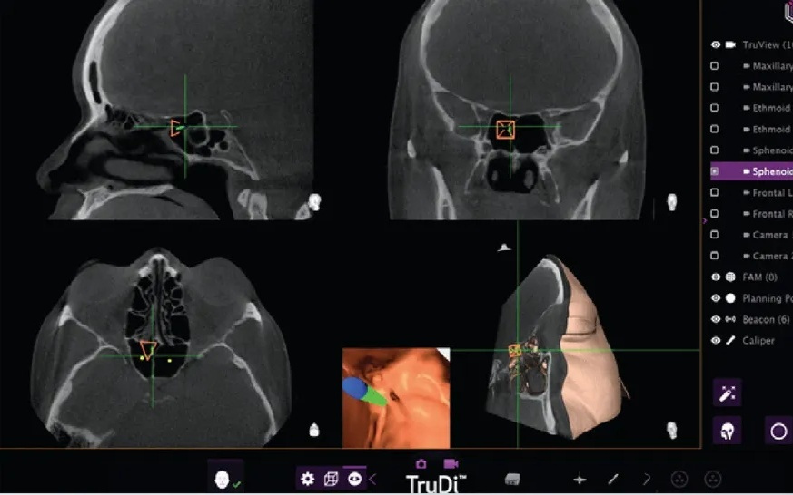 8→100起：鼻窦手术系统TruDi引入AI后故障激增1150%