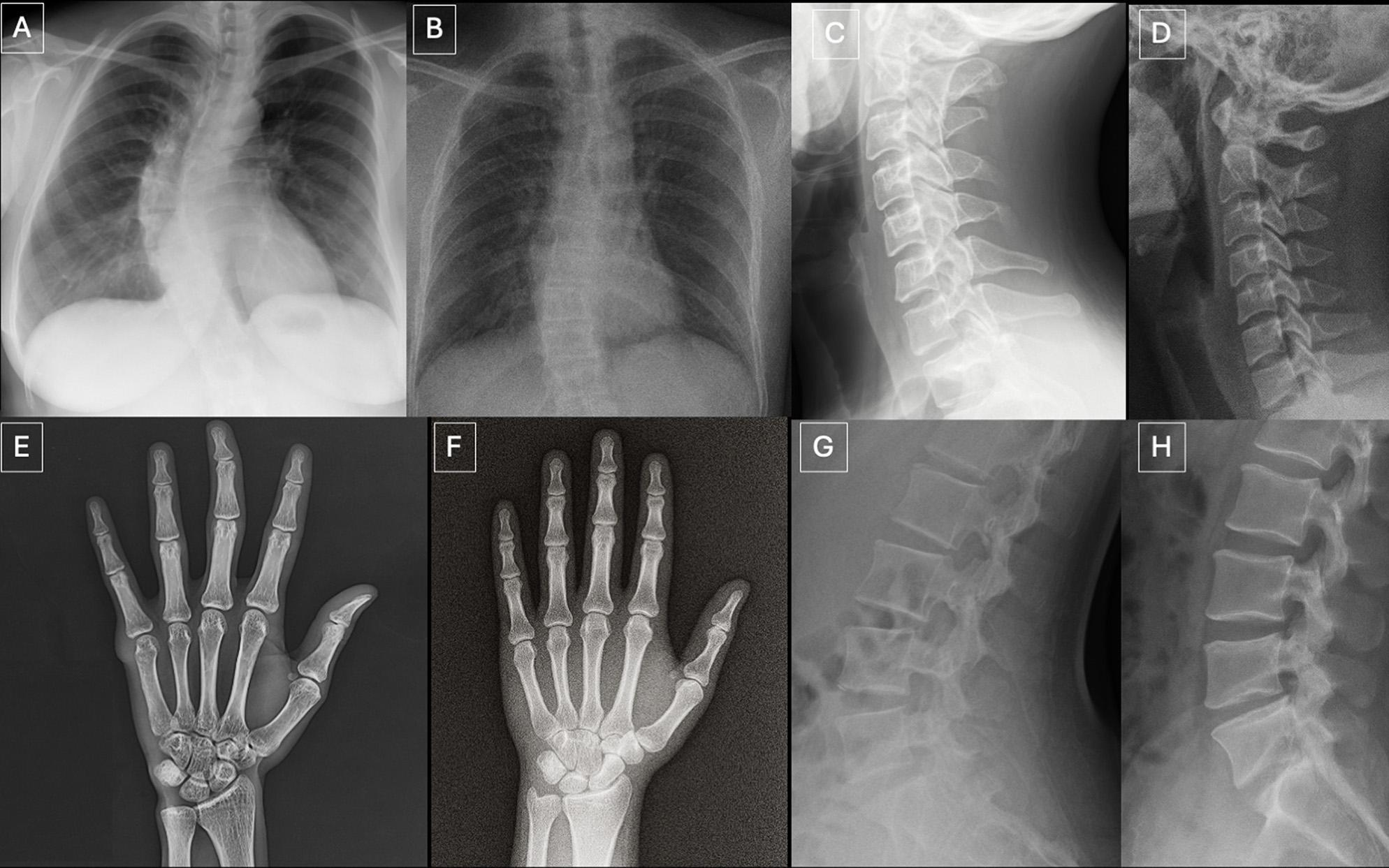 警惕！AI生成的深度伪造X光片能以假乱真