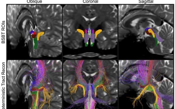 AI算法自动解析脑干白质神经束