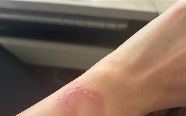苹果Apple Watch灼伤手腕!更痛的是心寒:维权半年处处碰壁