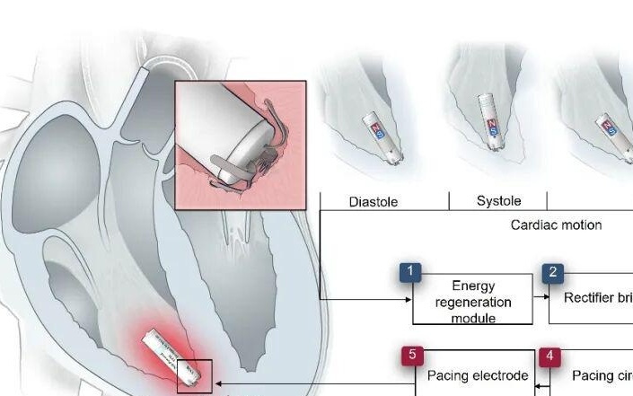 我国科学家研发出依靠心脏跳动自发电的起搏器，胶囊尺寸微创植入