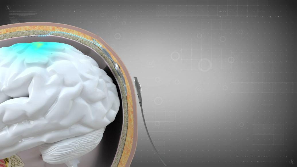 全球首款侵入式产品获批上市，中国脑机接口加速商业化