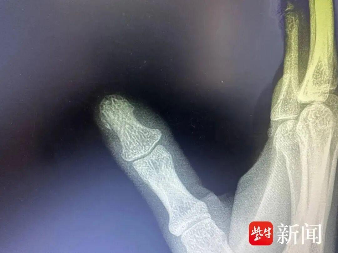 小米SU7电吸门夹手致苏州一女子骨折,最新后续:小米汽车官方发放1000积分“用户关怀” ,可兑换APP内百元商品