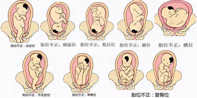 胎位不正怎么纠正（胎位不正怎么纠正方法图片）