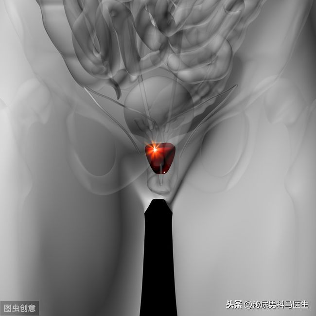 如何判断自己前列腺炎（如何判断自己前列腺炎图片）