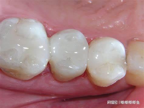 梦境解析，当牙齿与医生相遇——探索梦中牙齿损坏的深层含义