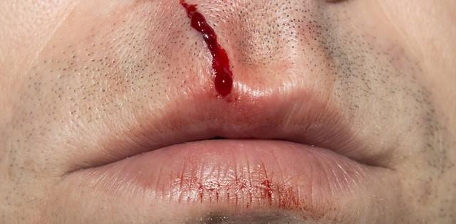 结婚前一晚梦到鼻子流血，梦境背后的深层含义与心理解析