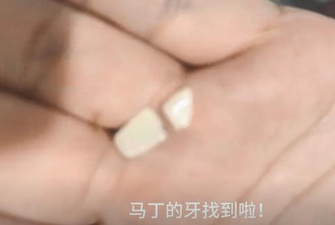 梦到上门牙断掉，预示变化与成长的象征