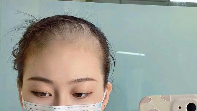 梦回青春，解读梦见自己头发白了脸上长满脸的斑的深层含义